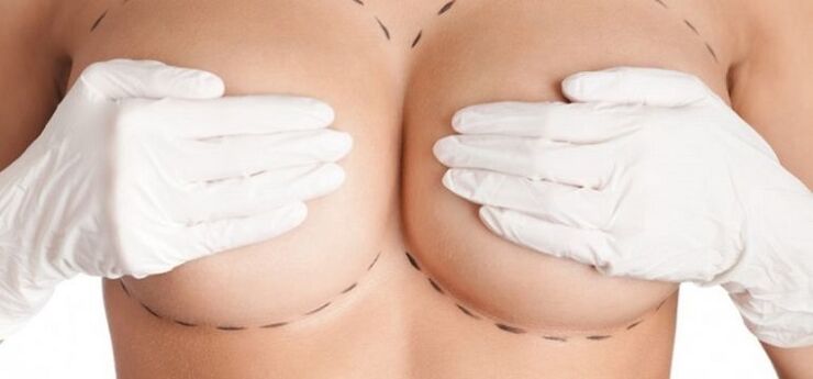 Αύξηση του μαστού μέσω χειρουργικής επέμβασης